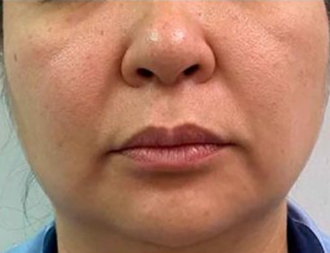 Antes da Radiofrequência Facial