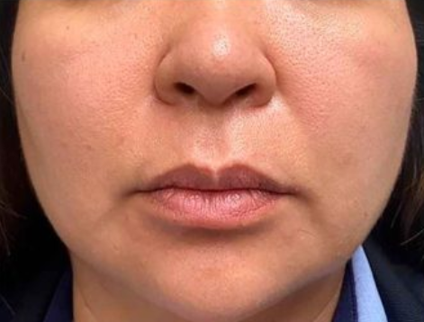 Depois da Radiofrequência Facial